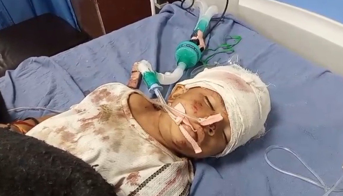 बाइक के सामने भैंस आने से फिसली गाड़ी, नौ वर्षीय बालिका घायल